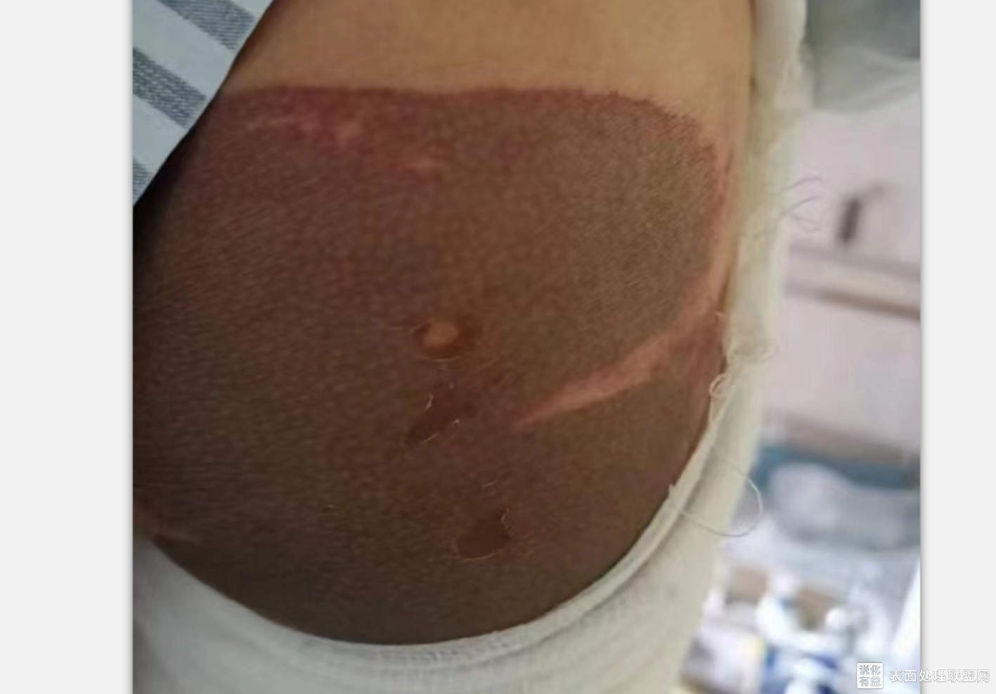 【新闻】广州通报“地铁硫酸灼伤男童”事件，嫌疑人已被控制